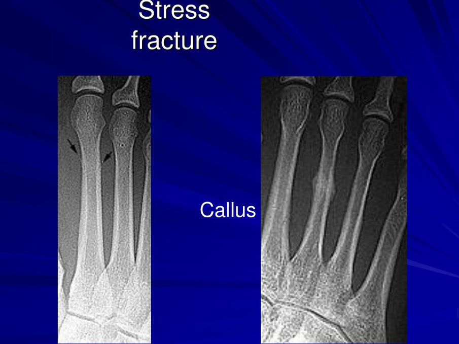 The Price for Pushing Your Limits: Stress Fractures and How to Lower your Risk